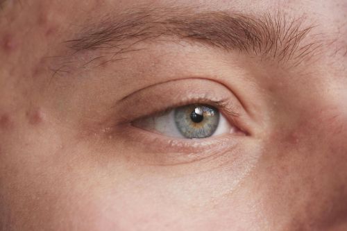 Extreme close-up of a man's face highlighting skin texture and acne with gray eyes.
