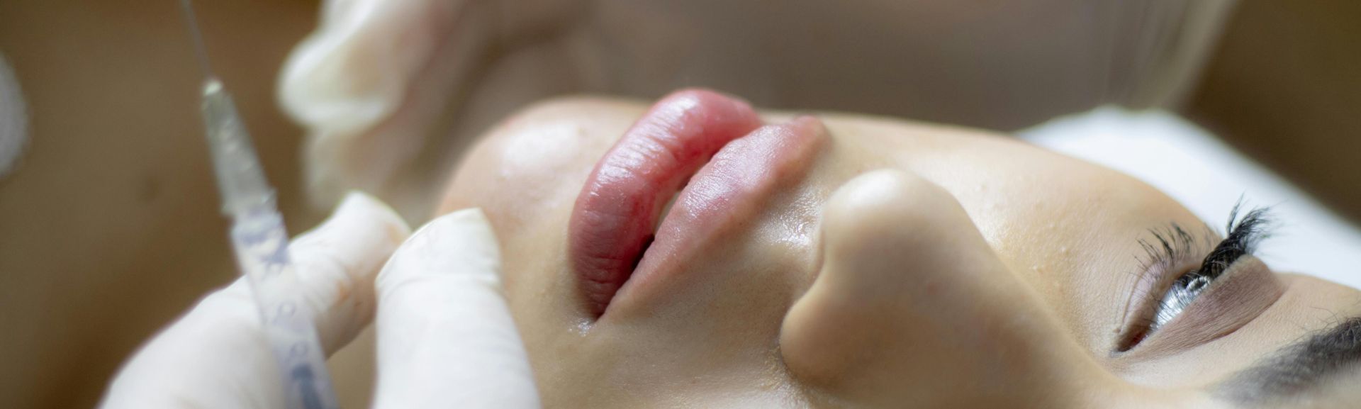 Close-up of a woman receiving a lip augmentation with a syringe by a professional.